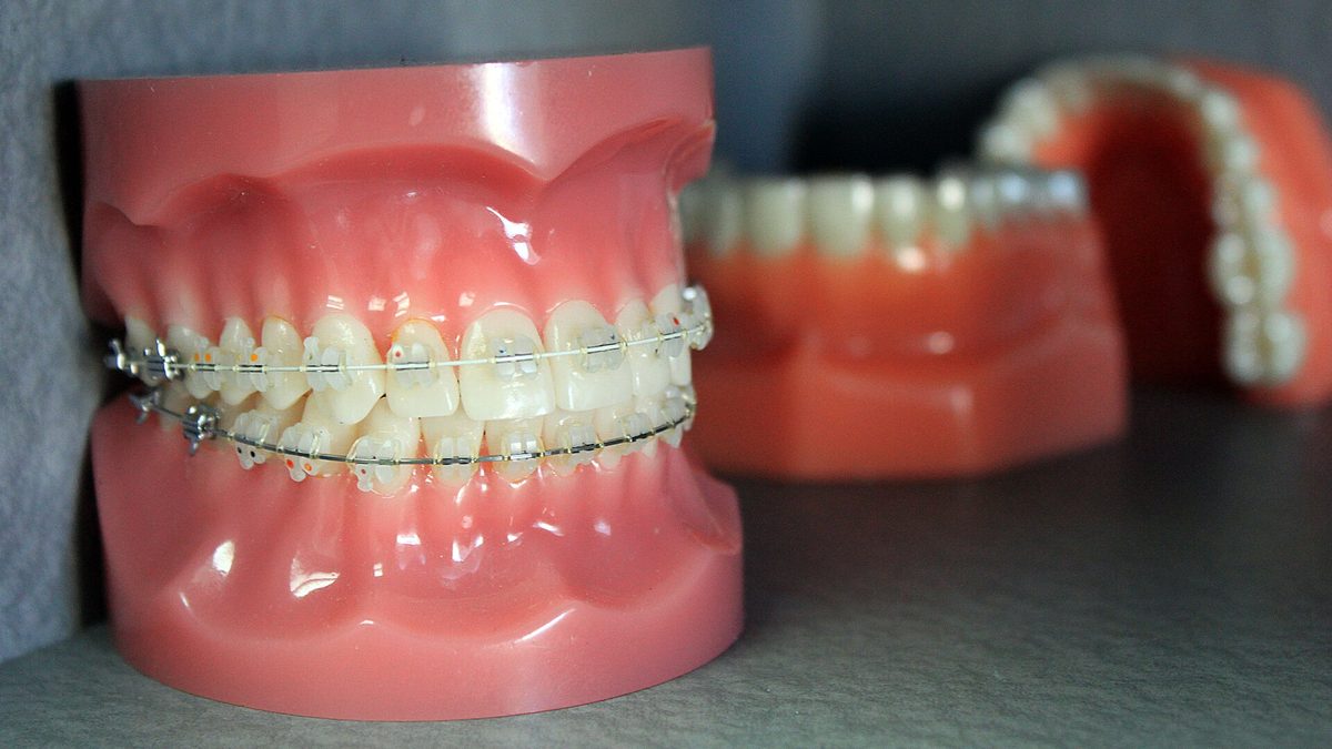 Gebissmodell mit festsitzender Zahnspange aus hellen Keramikbrackets und Drahtbogen